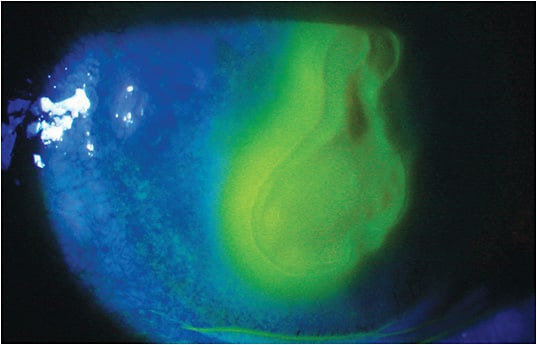 An amniotic graft helped this corneal ulcer patient.