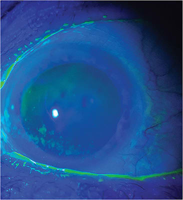 A 55-year-old female patient whose dry eye disease was discovered and addressed at her annual exam.Image courtesy of Dr. Koeeting