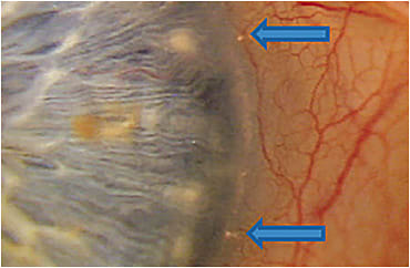 Nasal stents visible OD. Image courtesy of Dr. Lifferth. Image courtesy of Dr. Lifferth.