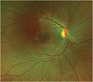 Mild nonproliferative diabetic retinopathy and diabetic macular edema.