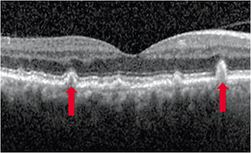 Depending on the stage of RPD development, it can appear as hyperreflective intraretinal deposits. Image courtesy of Dr. Nijm and Dr. Mary Beth Yackey.
