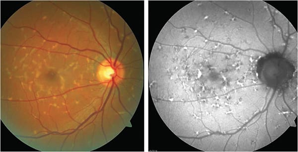 Figure 2. Clinical (left) and FAF image (right) of 57-year-old patient. Imaging found a number of yellow-orange pisciform flecks in his posterior poles.Images courtesy Dr. Nick Fogt.