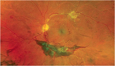 PDR-associated fibrosed neovascularization and vitreous hemorrhage. Images courtesy of Dr. Mohammad Rafieetary.