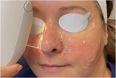 Figure 2. A patient undergoes intense pulsed light therapy to treat meibomian gland dysfunction.Photo courtesy of Dr. Melissa Barnett and Dr. Lisa Hornick.