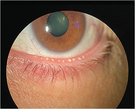 A patient presents with a thickened meibum. Sharing such images with the patient can help to explain why a specific supplement is recommended. Photo courtesy of Dr. Schaeffer.