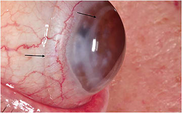 Scleral lens over eye with transplanted cornea. 
Image courtesy of Dr. Edward Boshnick