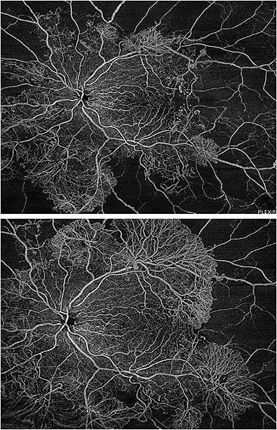 Case Study: Proliferative Diabetic Retinopathy
This is a case of a young diabetic patient with severe proliferative diabetic retinopathy in both eyes. The montage scan acquisition feature on the PLEX Elite 9000, from ZEISS, captures ultra-wide OCT angiography images that, in this case, helped the clinician clearly visualize the significant increase in the proliferation of new vessels in both eyes.
Images courtesy of Dr. Jean-François Korobelnik, University Hospital Pellegrin, Bordeaux, France.