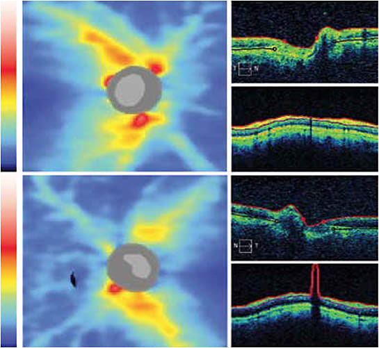 Glaucoma suspect: At right, RNFL thickness maps. At left, extracted horizontal tomograms and RNFL circular tomograms. OD top, OS bottom.
Courtesy of Leslie O’Dell, O.D.