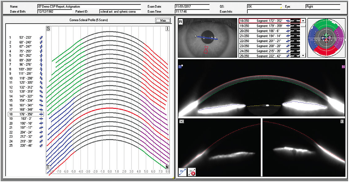 Note this corneo-scleral profile of a patient who presented with astigmatism. 
Image courtesy of Dr. Greg Roberts