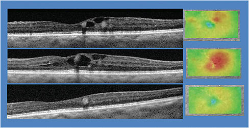 Diabetic macular edema shown on OCT, both in tomography and topography modes. Images courtesy of Dr. Mohammad Rafieetary