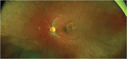 Red-free image of severe non-proliferative DR with three quadrants of intra-retinal hemorrhages, intra-retinal microvascular anomalies and a circinate ring of hard exudates suggestive of macular edema parafoveally. Optos images courtesy of Hannah Calvelli, O.D.