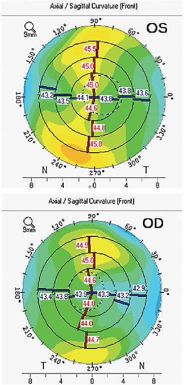 Figure 2. Topography of a patient considering ClearView 3 IOL shows regular astigmatism of less than 1.0D in both eyes.