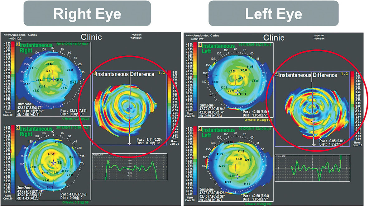 Figure 3. TVT treatment outcome (Nidek OPD). Microchanges in the cornea provide a binocular multifocal effect that improves near vision.
