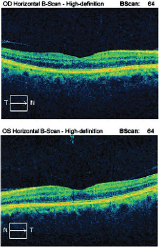 Figure 2. Optical coherence tomography of the macula