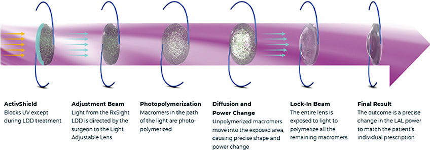 Figure 2. Light treatment after LAL implantation.
IMAGE PROVIDED BY RXSIGHT AND USED WITH PERMISSION.