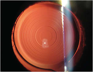 Figure 1. EDOF + multifocal hybrid. The Tecnis Synergy IOL utilizes a violet light filter, as noted on the slit-lamp light beam.
