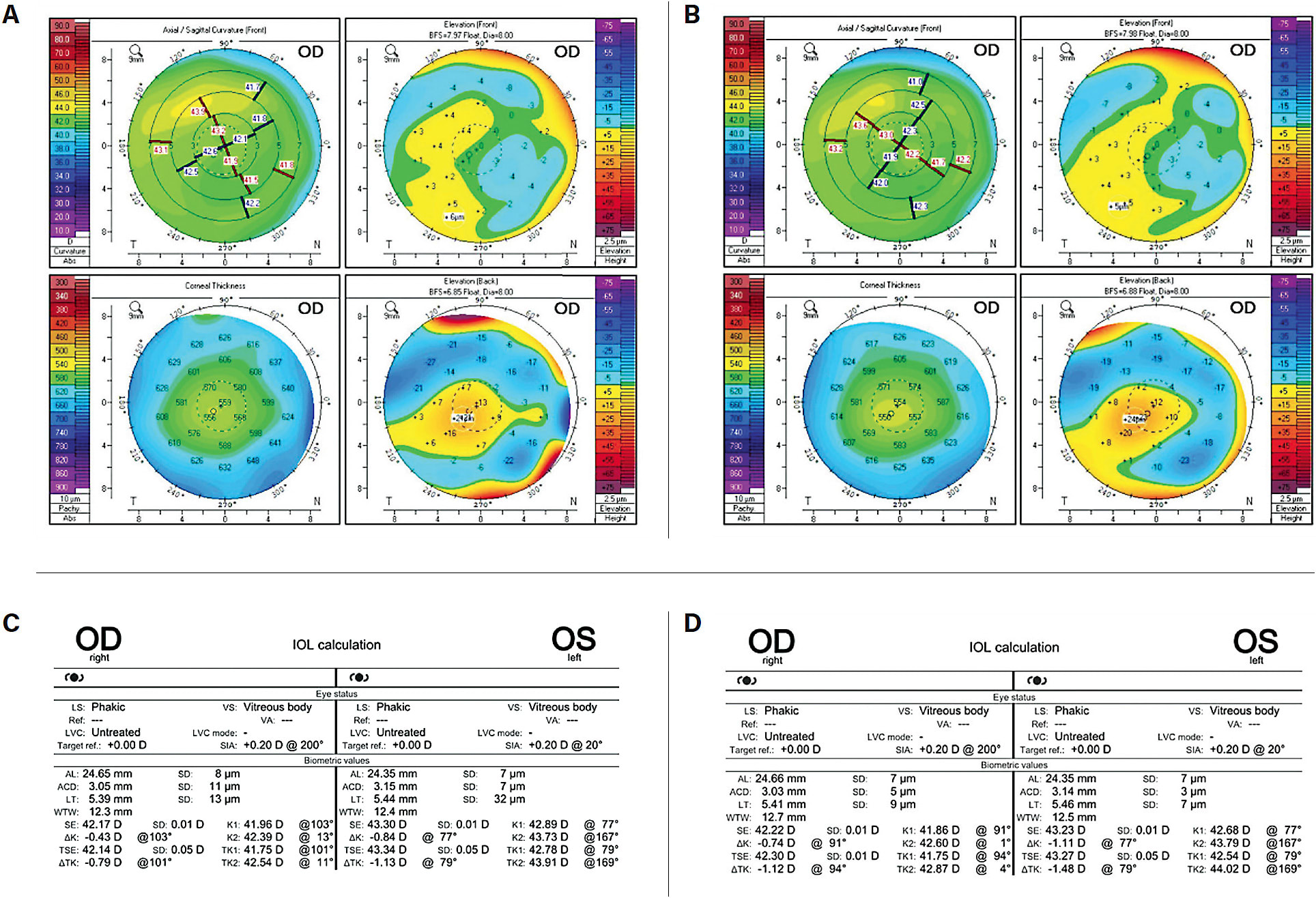 Figure 1. Pentacam imaging of the right eye before (A) and after (B) dry eye treatment shows reduced distortion and improved keratometry after treatment. Biometry measurements from the IOL Master 700 also changed from baseline (C) to post-dry eye treatment (D), with astigmatism changing most notably. The second set of measurements (B and D) were used to determine the IOL power and axis for a Tecnis Symfony OptiBlue lens in the dominant eye and a Tecnis Synergy toric lens in the nondominant eye. The patient had an excellent outcome, with binocular distance acuity of 20/20 and J1&#x2B; near visual acuity.