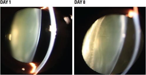 Figure 2. Increased clarity of the lens of a 17-year-old cynomolgus monkey with a naturally occurring cataract 8 days following treatment with 25-HC by IVT.