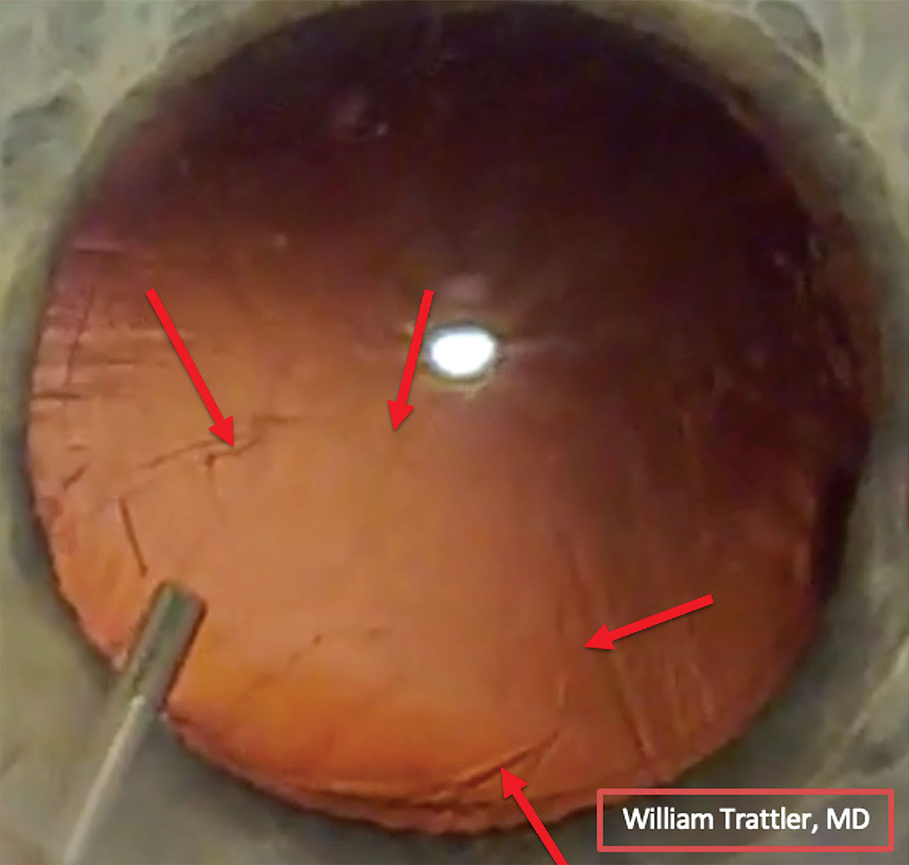 Figure 1. Posterior capsular opening present after cortex removal and before IOL placement.