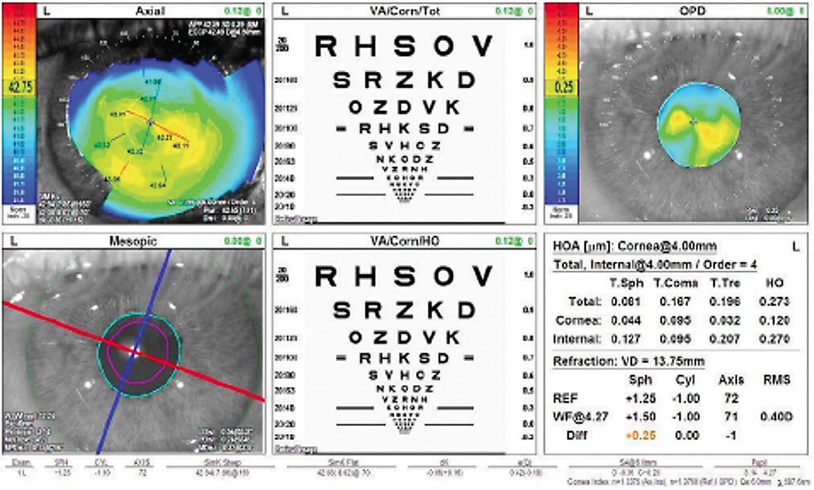 Figure 2. OPD scan (Nidek). Shows anterior corneal elevation (topography) top left with correlated keratometry values. Also quantifies cornea and internal higher order aberrations (HOAs). Finally, adds value for pupil size and comparison of the visual axis to pupillary axis (Angle K).