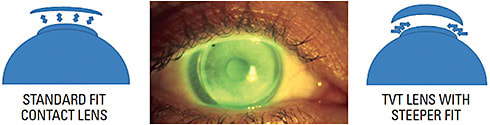 Figure 2. TVT treatment mechanism of action. Changes to the aspheric corneal surface of a multifocal cornea.