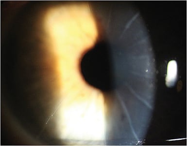 Figure 6. Slit lamp view of RK incisions OS. Figures 7 and 8 show biometry.
