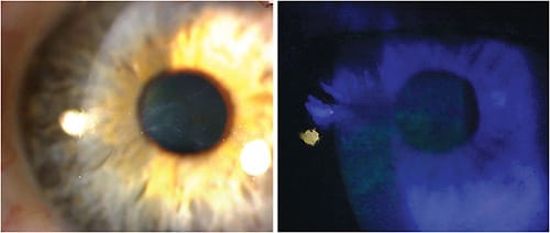 Figure 2. Examples of central epithelial basement membrane dystrophy (left) and central punctate keratitis (right) significant for ocular surface disease.