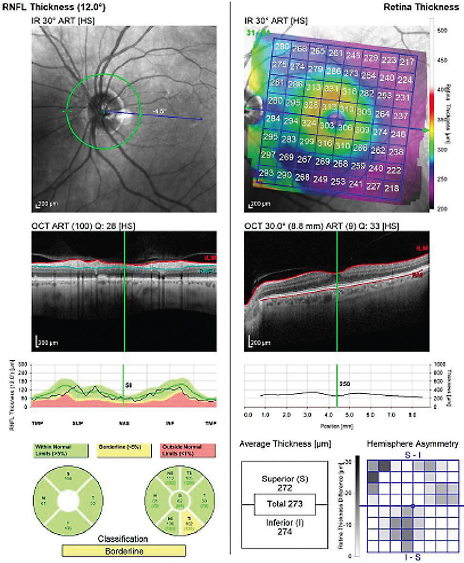 Figure 1. Optic nerve (RNFL) and macula optical coherence tomography (OCT) OS. Biometry is shown in figures 2 and 3.