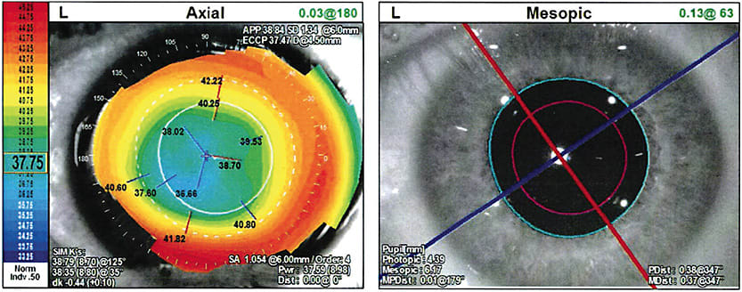 Figure 7. OPD scan (Nidek) of OS.