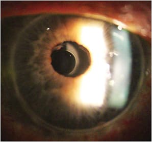 Figure 3. Small aperture IOL (Apthera &amp;#x2013; AcuFocus/Bausch&amp;#x2B;Lomb) under a penetrating keratoplasty. Surgery performed by John Berdahl, MD. PICTURE TAKEN BY BRENT KRAMER, MD (VANCE THOMPSON VISION).