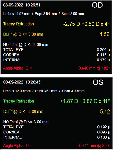 Figure 3. iTrace imaging measures a large angle alpha on a patient considering multifocal implantation.