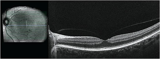 Figure 2. Vitreofoveal traction.