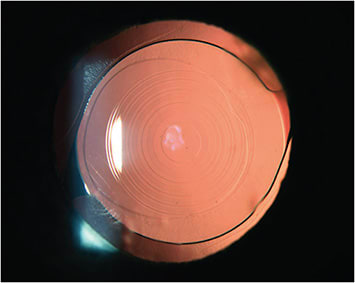 Figure 3. The PanOptix IOL. PHOTO COURTESY OF AARON BRONNER, OD.