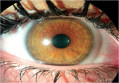 Figure 1. Soft silicone hydrogel multifocal lens on eye.