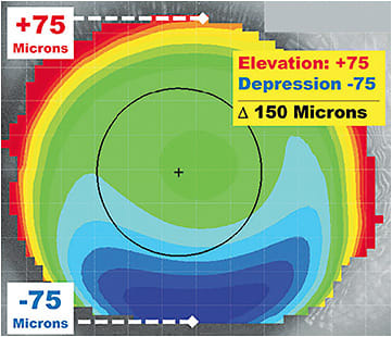 Figure 1. An elevation difference of 150µm makes this eye an ideal candidate for a corneal GP lens.