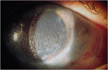 Figure 2. A scleral lens with crazing.