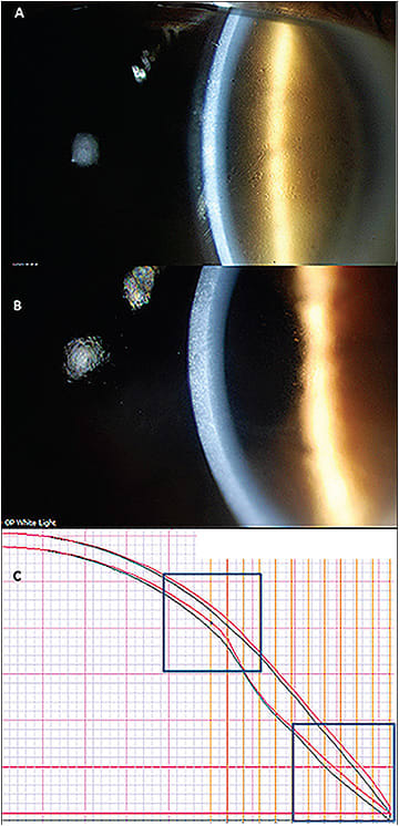 Figure 4. Diffuse epithelial corneal edema as a result of crowding/touch along the limbal region and a tight-fitting lens—contributing to lens suction and difficult removal (A). Edema was resolved (B) after increasing the limbal clearance and flattening/loosening the haptic (C).
Image courtesy of Karen G. Carrasquillo, OD, PhD