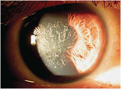 Figure 1. Granular-lattice dystrophy.