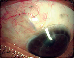 Figure 3. The 13.0mm soft contact lens at the site of the filtering bleb.