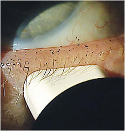 Figure 1. Assess meibomian gland function by grading the quality of the meibum produced.