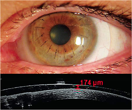 Figure 7. A highly oblate corneal graft was evaluated using a corneo-scleral topographer for scleral lens fitting. The resultant scleral lens incorporated 19D of reverse geometry in its design with 174 microns of clearance after lens settling.
Images Courtesy of Gregory W. DeNaeyer, OD