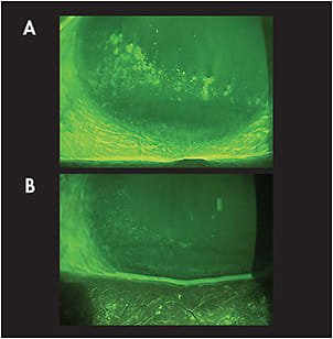 Figure 1. The patient’s initial presentation (A) and at a two-week follow up (B).