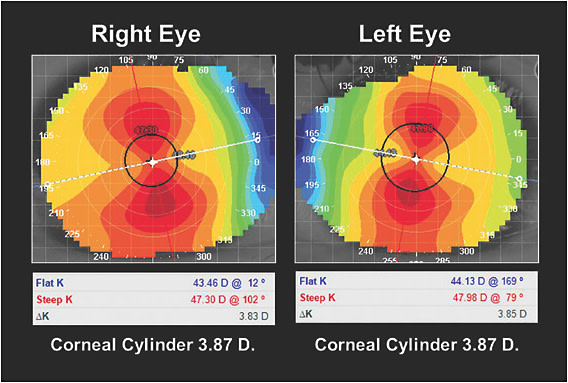 Figure 1. The corneal topography showing –3.87D of with-the-rule astigmatism.