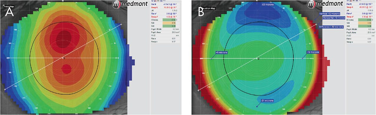 Figure 1. Pre-treatment axial map showing 1.75D of central with-the-rule astigmatism (A) and elevation (B). This example shows a 32-micron elevation difference between the vertical and horizontal landing points.