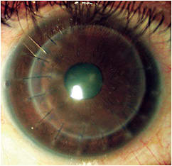 Figure 2. The 13.0mm soft contact lens in primary position with lens rotation markers along the horizontal meridian.