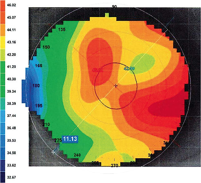 Figure 2. Topography display showing an asymmetrical pattern.
Images courtesy of Tom Arnold, OD