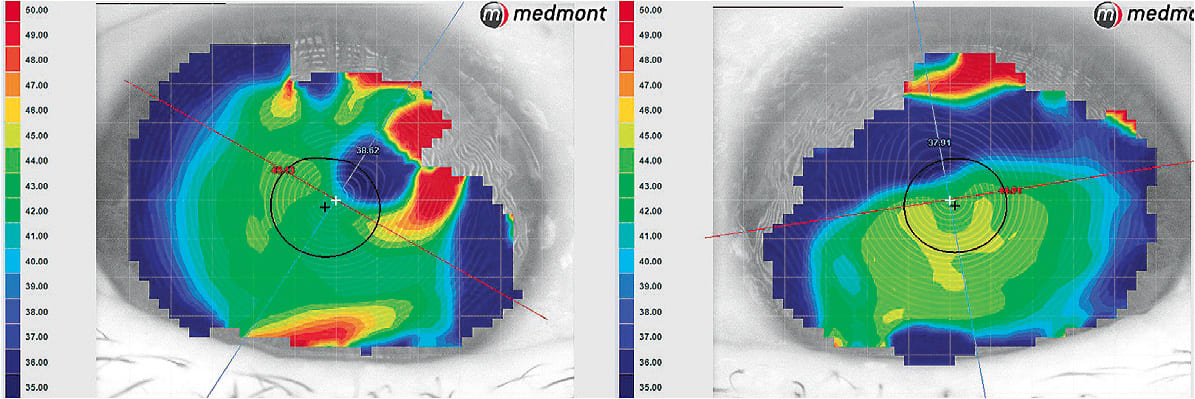 Figure 2. Robyn’s corneal topography (tangential curvature) showing OD 6.51D and OS 7.00D of irregular astigmatism due to Salzmann’s nodular degeneration.