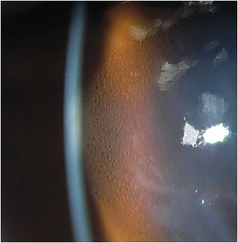 Figure 6. Microcystic epithelial edema (MCE) as seen by retroillumination.
Image courtesy of Karen G. Carrasquillo, OD, PhD