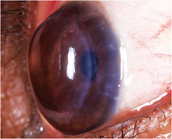 Figure 1. A clear, full-thickness corneal graft that is tilted and has a large amount of irregular astigmatism.