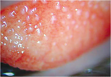 Figure 1. Papillary conjunctivitis in a SiHy lens wearer.